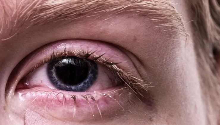 Şimdi tam zamanı! Bahardaki göz alerjisi görme kaybına kadar götürüyor