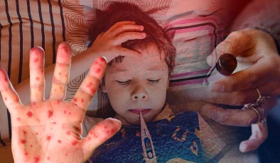 10 kişiden 9’una bulaşıyor! Kızamık Avrupa’yı sarstı, Türkiye’de son durum ne?