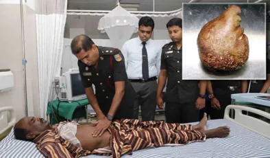 Sri Lanka’da bir hastadan 3,1 kilogram ağırlığında mesane taşı çıkarıldı