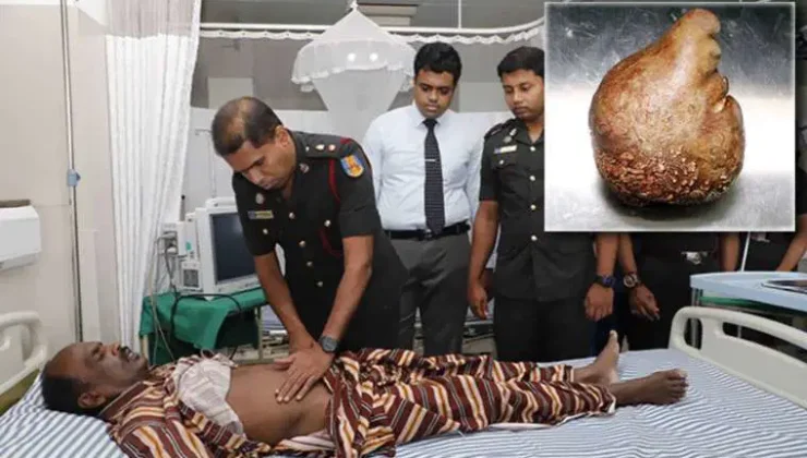 Sri Lanka’da bir hastadan 3,1 kilogram ağırlığında mesane taşı çıkarıldı