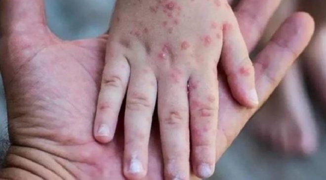 Güney Afrika’da son 5 haftada 13 M çiçeği vakası kaydedildi