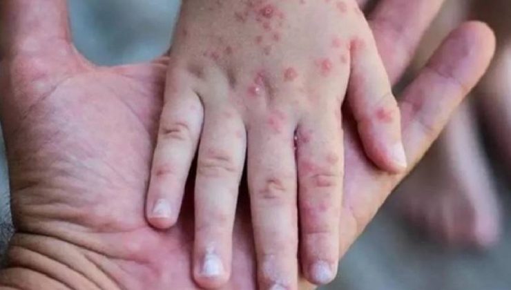 Güney Afrika’da son 5 haftada 13 M çiçeği vakası kaydedildi