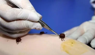 ABD’de her yıl 476 bin kişiye Lyme hastalığı teşhisi konuyor