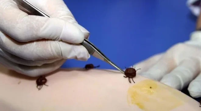 ABD’de her yıl 476 bin kişiye Lyme hastalığı teşhisi konuyor