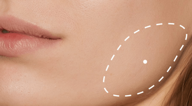 Bruksizmde masseter botoksu tek başına çözüm değil