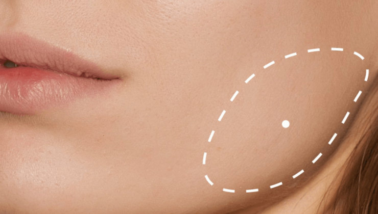Bruksizmde masseter botoksu tek başına çözüm değil
